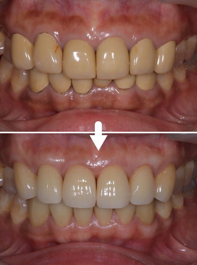手術と部分矯正、前歯１２本分のかぶせ物