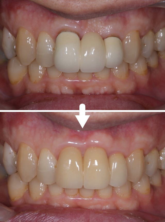 手術と前歯3本分のかぶせ物